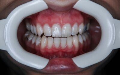 Understanding Periodontal Disease: A Deep Dive from Your Leesburg Periodontist